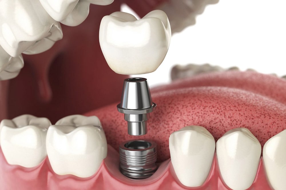 Studio dentistico Riva| Figino Serenza| Alzate Brianza| quanto dura un impianto dentale