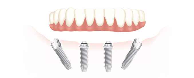 Studio dentistico Riva| Figino Serenza| Alzate Brianza| impianti dentali